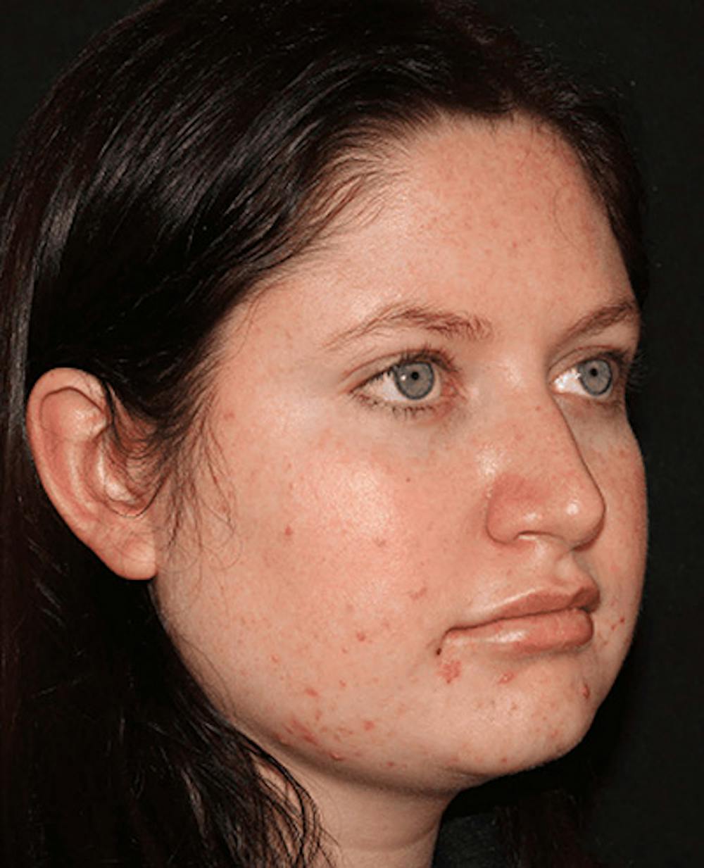 Lip Filler Before & After Gallery - Patient 141186434 - Image 6