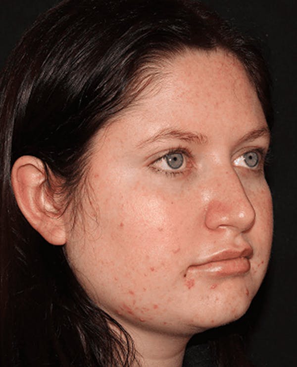 Lip Filler Before & After Gallery - Patient 141186434 - Image 6