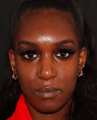 Lip Filler Before & After Gallery - Patient 141186443 - Image 1