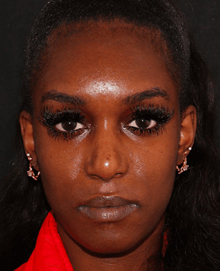 Lip Filler Before & After Gallery - Patient 141186443 - Image 1