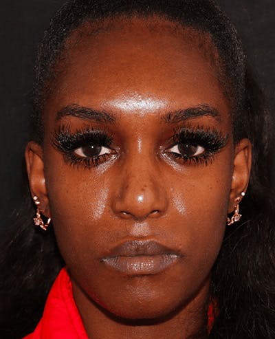 Lip Filler Before & After Gallery - Patient 141186443 - Image 2