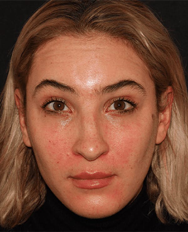Lip Filler Before & After Gallery - Patient 141186429 - Image 1