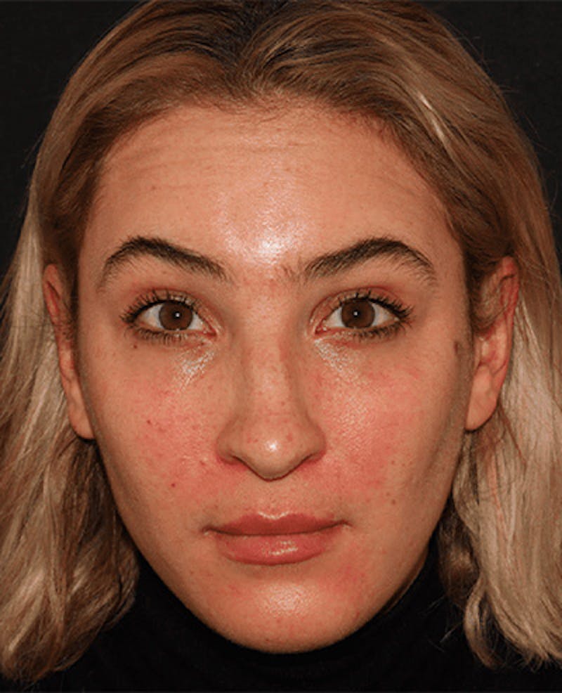 Lip Filler Before & After Gallery - Patient 141186429 - Image 1