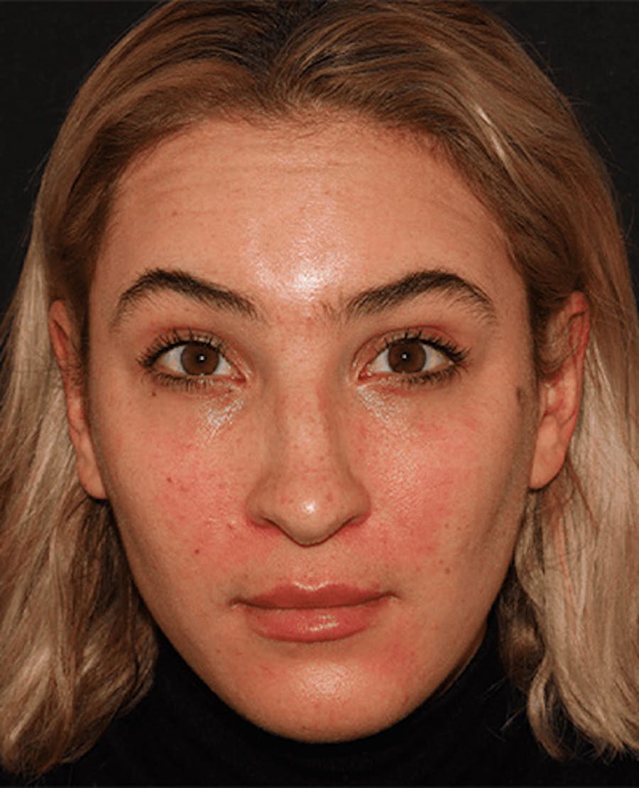Lip Filler Before & After Gallery - Patient 141186429 - Image 1