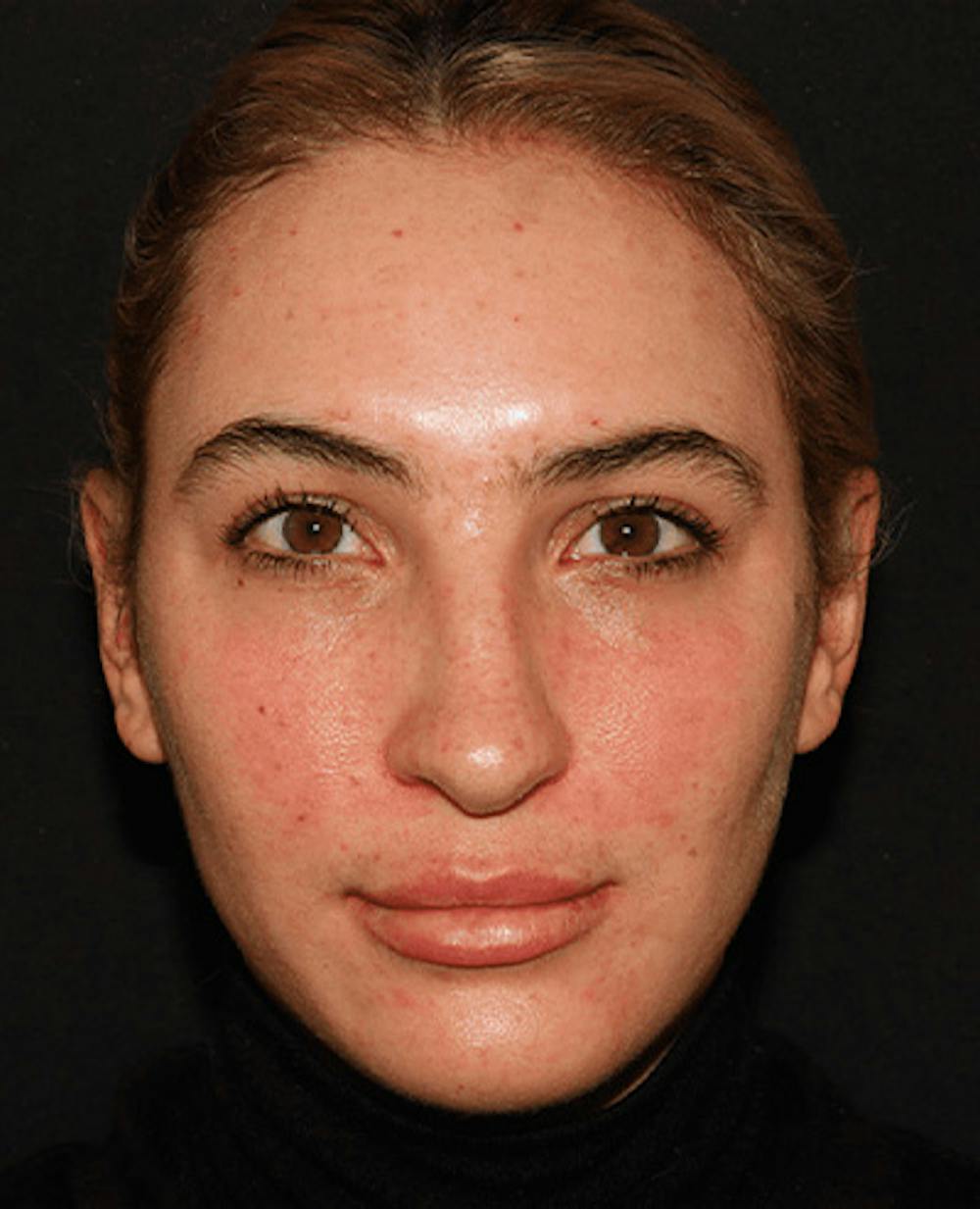 Lip Filler Before & After Gallery - Patient 141186429 - Image 2