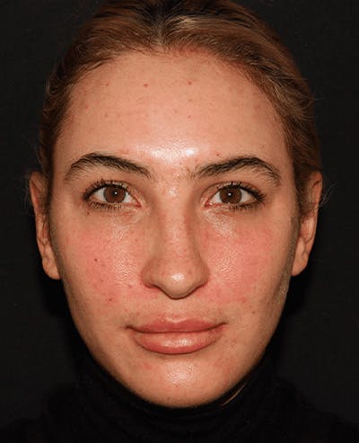 Lip Filler Before & After Gallery - Patient 141186429 - Image 2