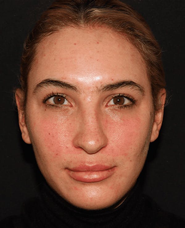 Lip Filler Before & After Gallery - Patient 141186429 - Image 2
