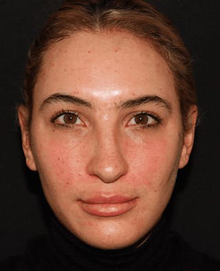 Lip Filler Before & After Gallery - Patient 141186429 - Image 2