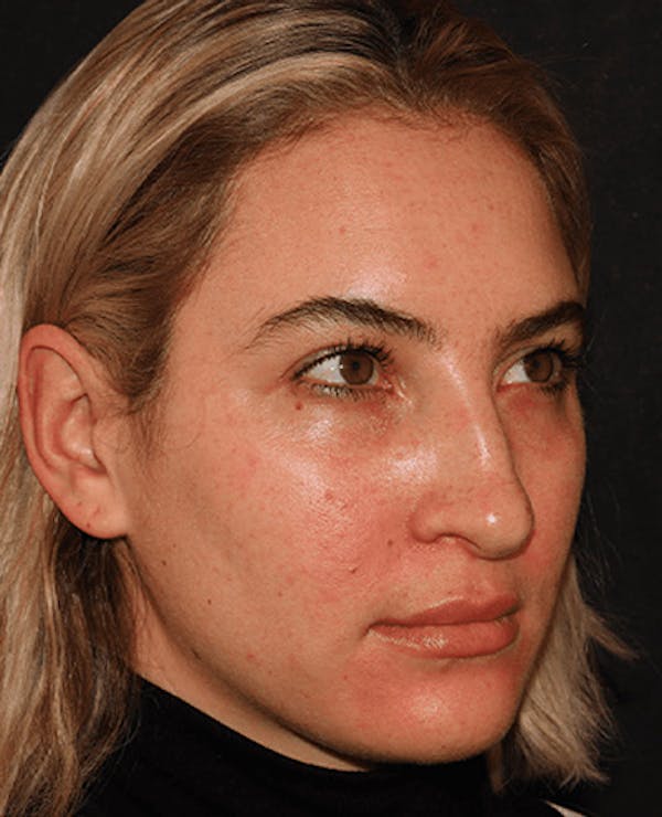 Lip Filler Before & After Gallery - Patient 141186429 - Image 3