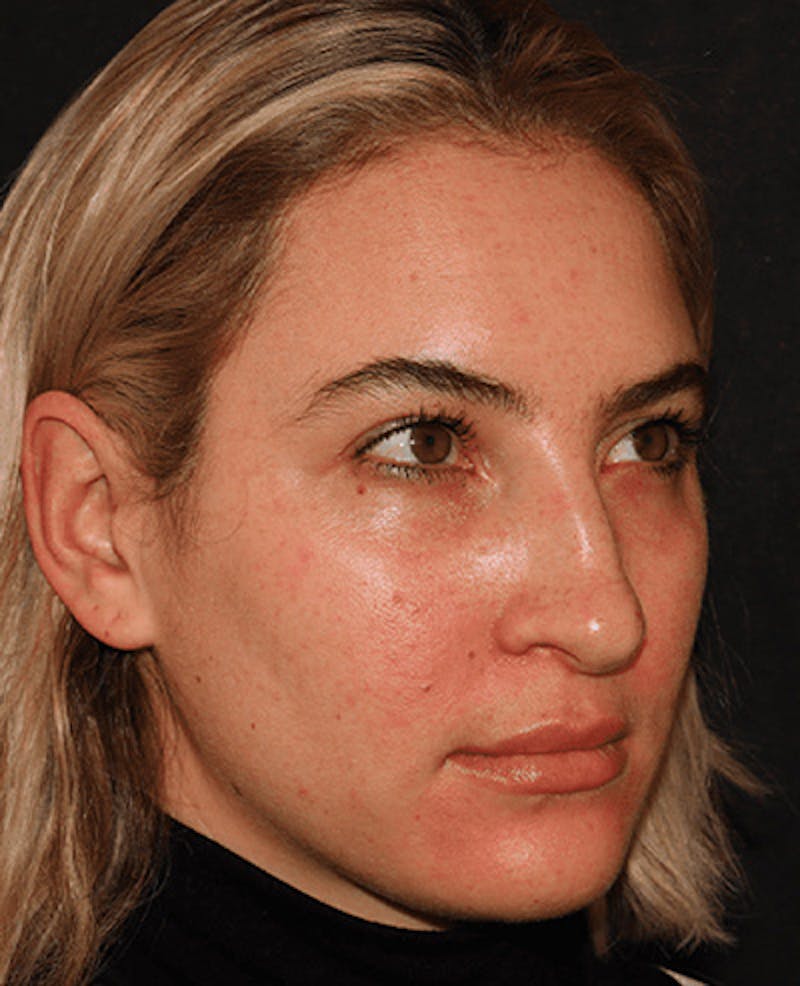 Lip Filler Before & After Gallery - Patient 141186429 - Image 3