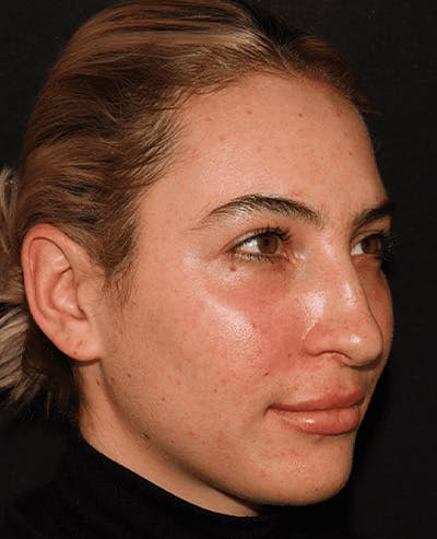 Lip Filler Before & After Gallery - Patient 141186429 - Image 4