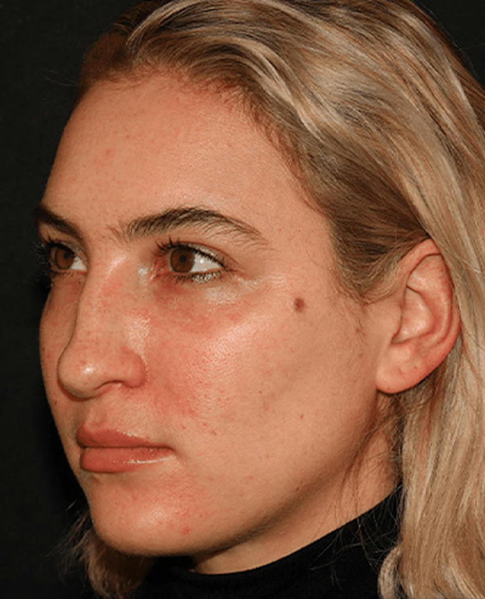 Lip Filler Before & After Gallery - Patient 141186429 - Image 5