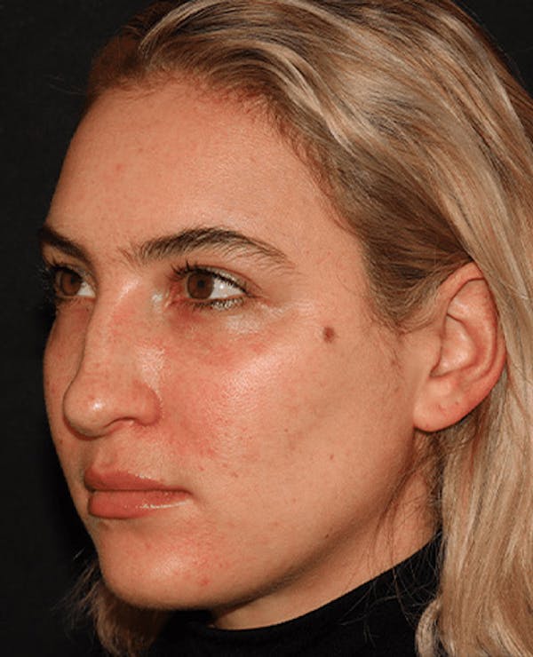 Lip Filler Before & After Gallery - Patient 141186429 - Image 5