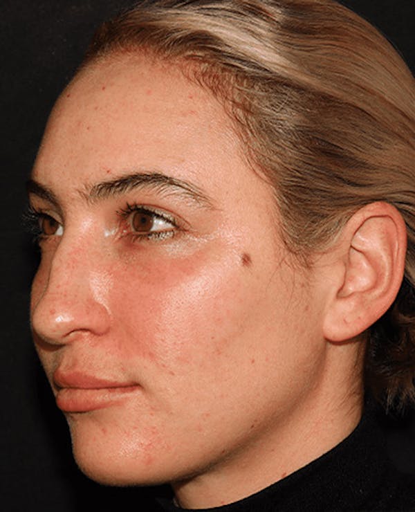 Lip Filler Before & After Gallery - Patient 141186429 - Image 6