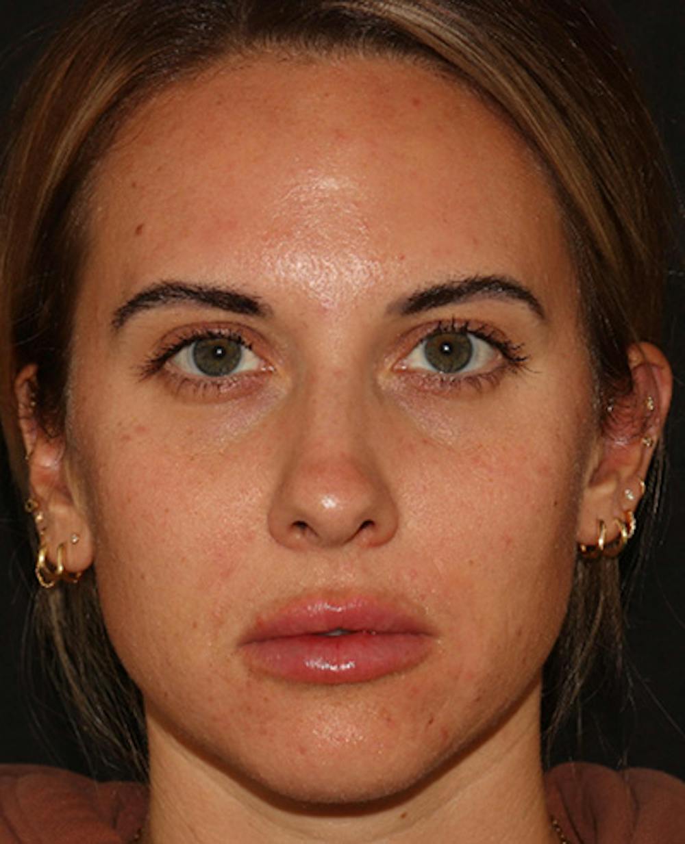 Lip Filler Before & After Gallery - Patient 143617242 - Image 2