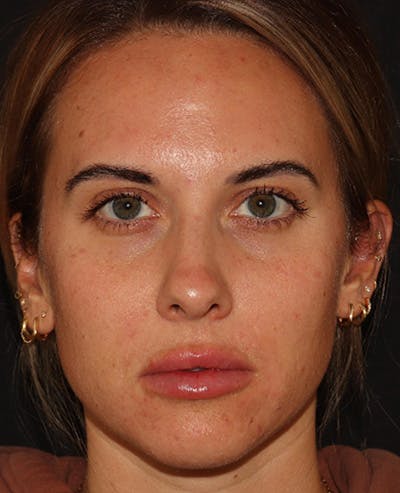 Lip Filler Before & After Gallery - Patient 143617242 - Image 2
