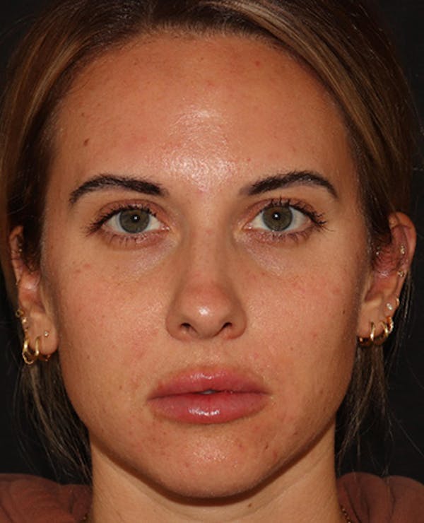 Lip Filler Before & After Gallery - Patient 143617242 - Image 2