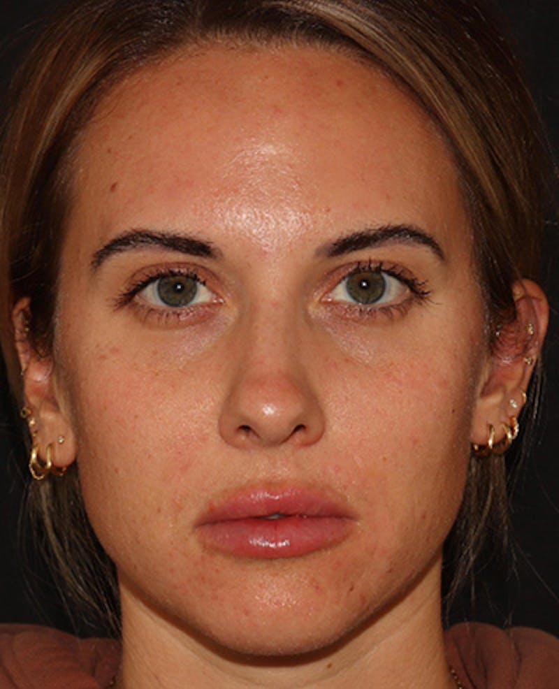 Lip Filler Before & After Gallery - Patient 143617242 - Image 2
