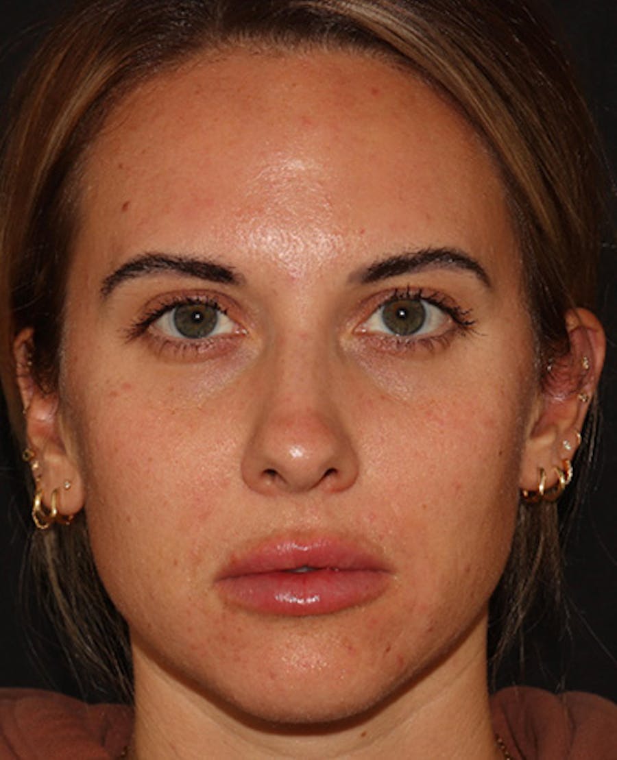 Lip Filler Before & After Gallery - Patient 143617242 - Image 2