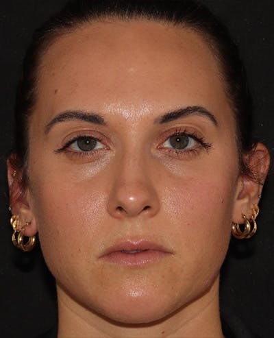 Lip Filler Before & After Gallery - Patient 143617242 - Image 1
