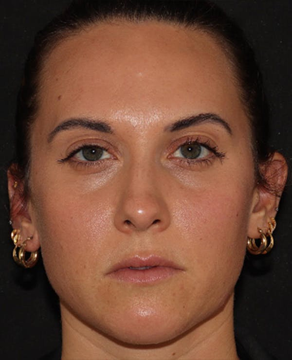 Lip Filler Before & After Gallery - Patient 143617242 - Image 1
