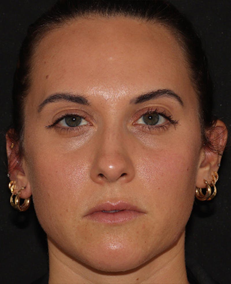 Lip Filler Before & After Gallery - Patient 143617242 - Image 1