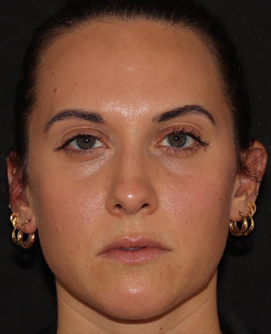 Lip Filler Before & After Gallery - Patient 143617242 - Image 1