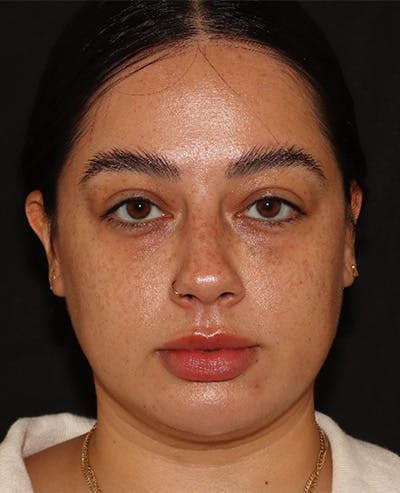 Lip Filler Before & After Gallery - Patient 143617243 - Image 1