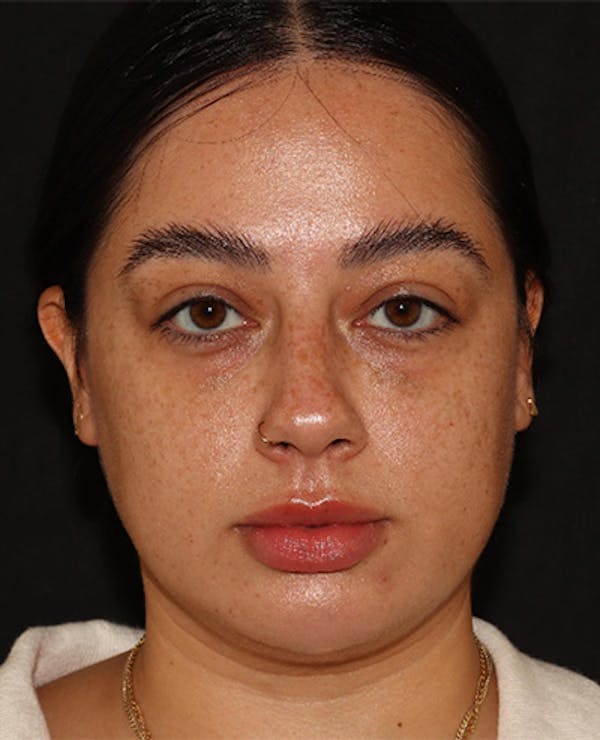 Lip Filler Before & After Gallery - Patient 143617243 - Image 1