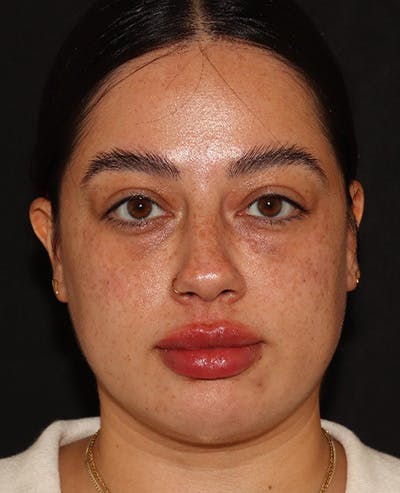 Lip Filler Before & After Gallery - Patient 143617243 - Image 2