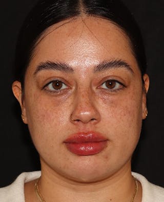 Lip Filler Before & After Gallery - Patient 143617243 - Image 2