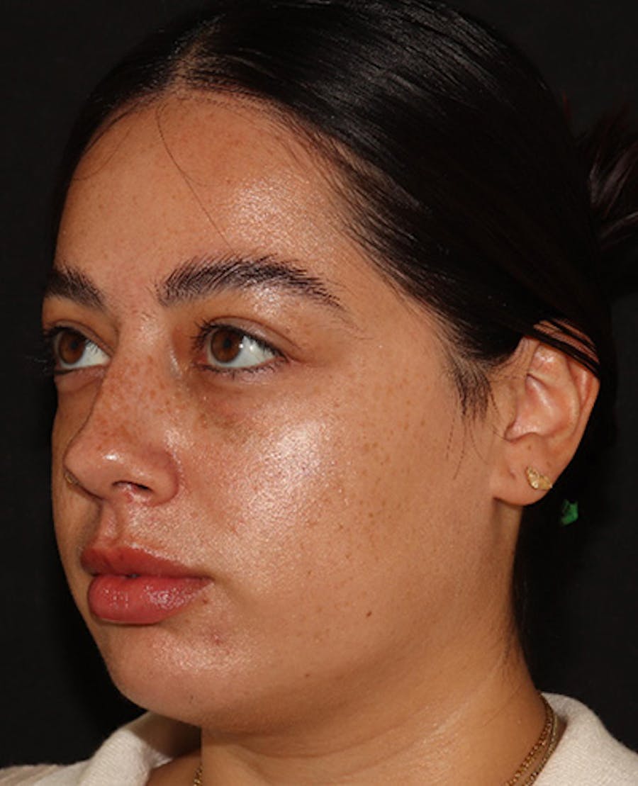 Lip Filler Before & After Gallery - Patient 143617243 - Image 4