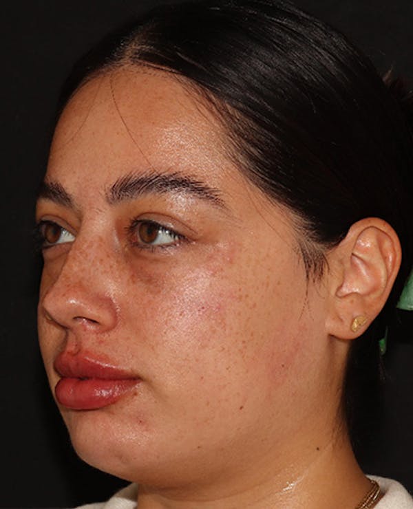 Lip Filler Before & After Gallery - Patient 143617243 - Image 3