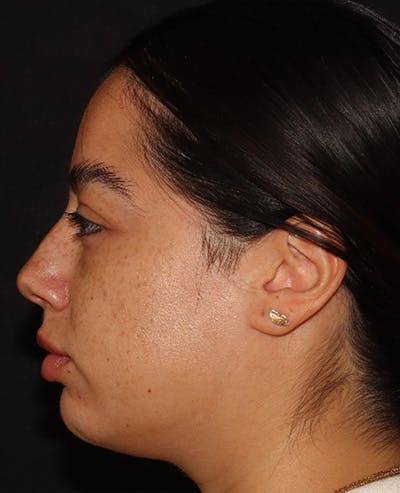 Lip Filler Before & After Gallery - Patient 143617243 - Image 5