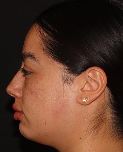 Lip Filler Before & After Gallery - Patient 143617243 - Image 6