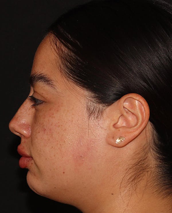 Lip Filler Before & After Gallery - Patient 143617243 - Image 6