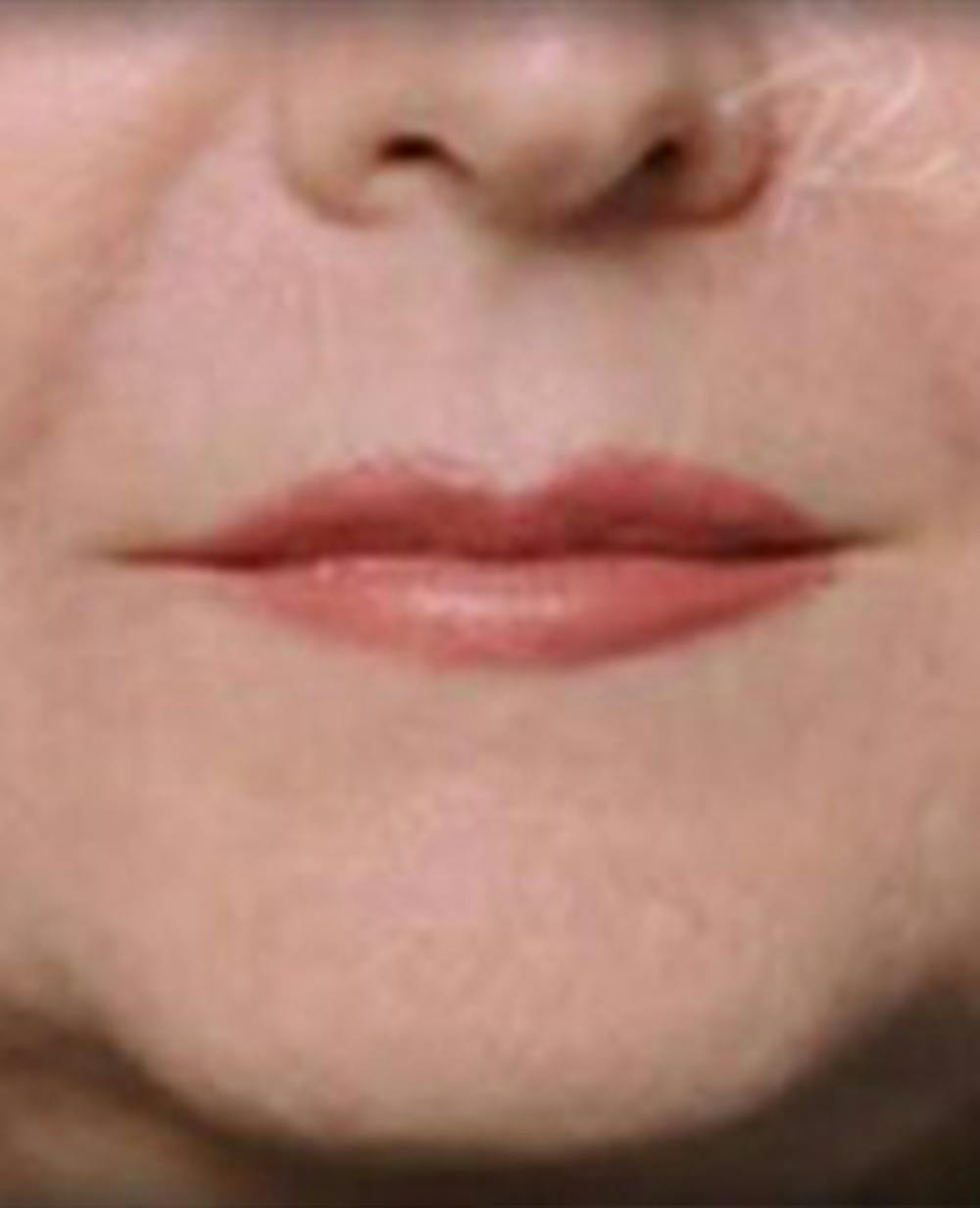 Lip Filler Before & After Gallery - Patient 414199 - Image 1