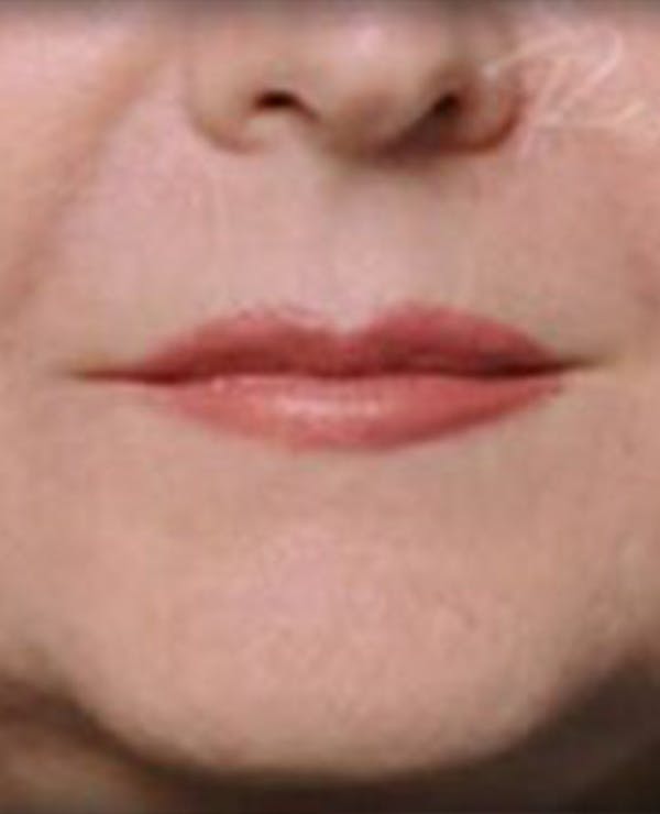 Lip Filler Before & After Gallery - Patient 414199 - Image 1