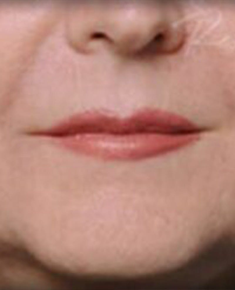 Lip Filler Before & After Gallery - Patient 414199 - Image 1