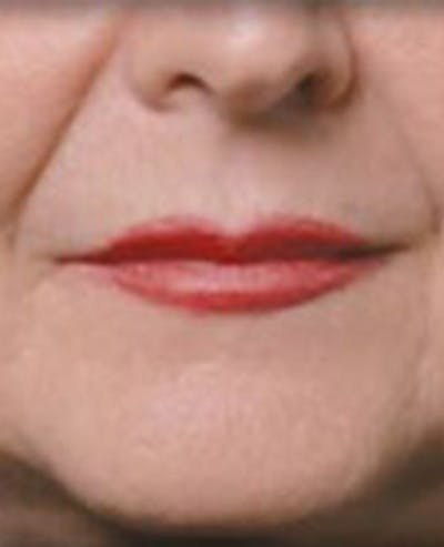 Lip Filler Before & After Gallery - Patient 414199 - Image 2
