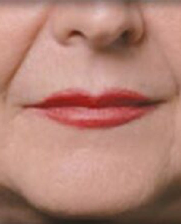 Lip Filler Before & After Gallery - Patient 414199 - Image 2