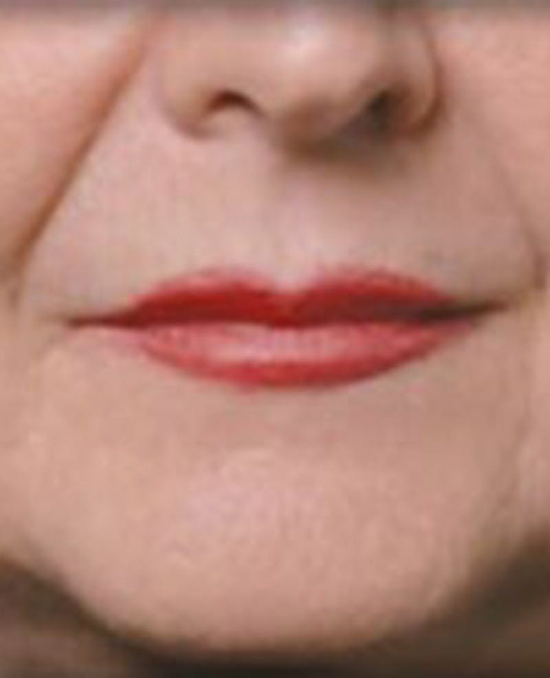 Lip Filler Before & After Gallery - Patient 414199 - Image 2
