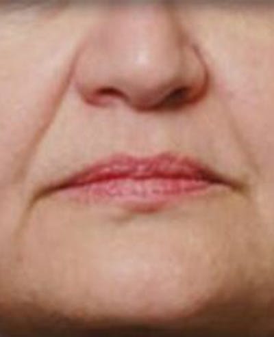 Lip Filler Before & After Gallery - Patient 381365 - Image 1