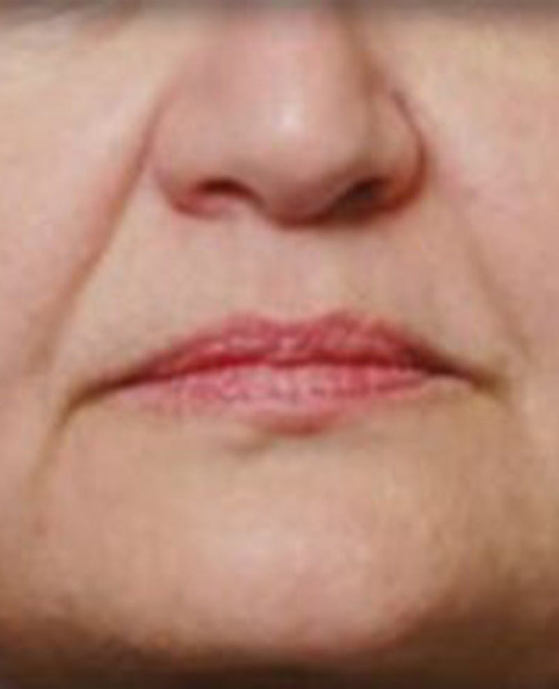 Lip Filler Before & After Gallery - Patient 381365 - Image 1