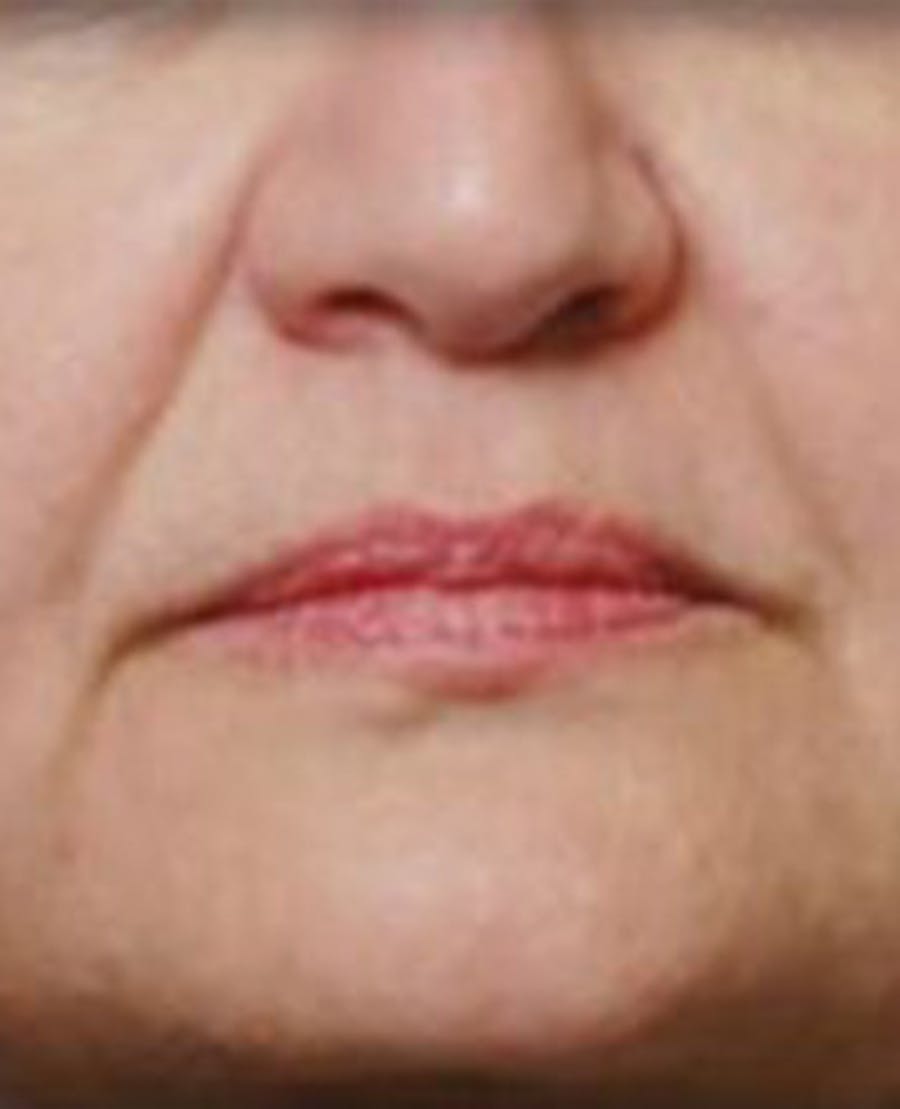 Lip Filler Before & After Gallery - Patient 381365 - Image 1