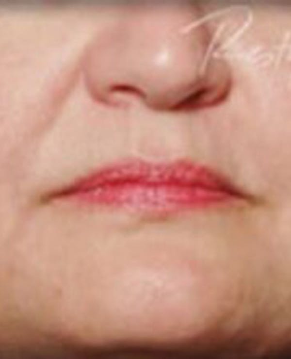 Lip Filler Before & After Gallery - Patient 381365 - Image 2