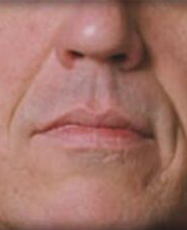 Lip Filler Before & After Gallery - Patient 366821 - Image 1
