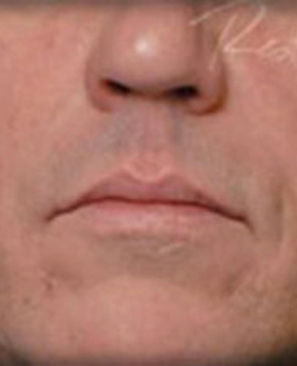 Lip Filler Before & After Gallery - Patient 366821 - Image 2