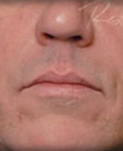 Lip Filler Before & After Gallery - Patient 366821 - Image 2