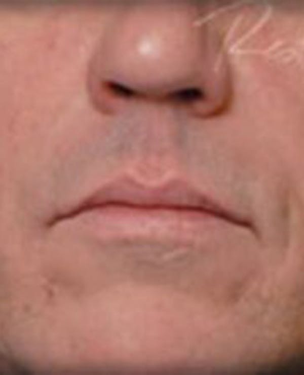 Lip Filler Before & After Gallery - Patient 366821 - Image 2